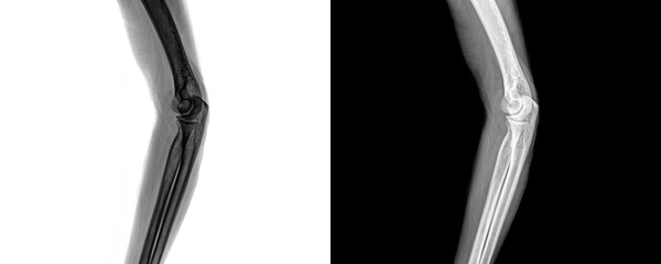Elbow Lateral Projection X-Ray Image Depicting Precise Bone Structure and Joint Orientation for Fracture Detection and Isolated on Transparent Background