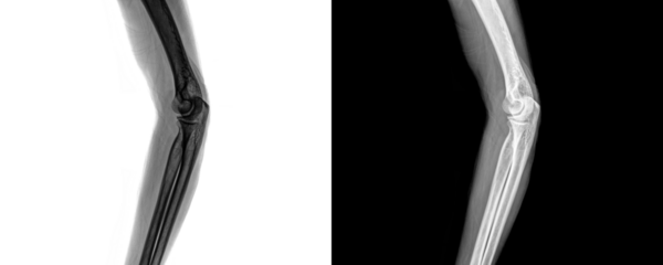 Elbow Lateral Projection X-Ray Image Depicting Precise Bone Structure and Joint Orientation for Fracture Detection and Isolated on Transparent Background