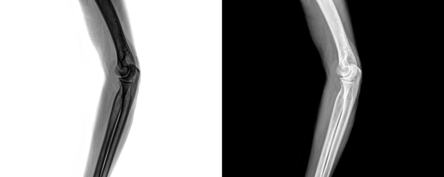 Elbow Lateral Projection X-Ray Image Depicting Precise Bone Structure and Joint Orientation for Fracture Detection and Isolated on Transparent Background