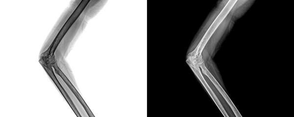 Elbow Lateral Projection X-Ray Image Displaying Bone Integrity and Joint Orientation for Precise Identification of Fractures Isolated on Transparent Background