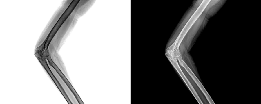 Elbow Lateral Projection X-Ray Image Displaying Bone Integrity and Joint Orientation for Precise Identification of Fractures Isolated on Transparent Background