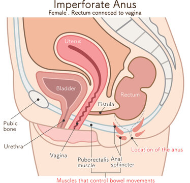 女性の鎖肛_直腸膣ろう_imperforate anus(ARM) illustration