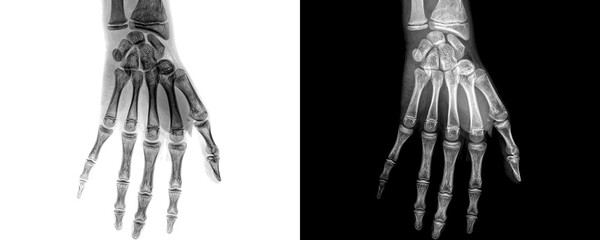 Wrist Joint Anterior View X-Ray Radiograph Showing Bone Alignment and Soft Tissue Structures for Diagnosis of Fractures, Arthritis, Isolated on Transparent Background