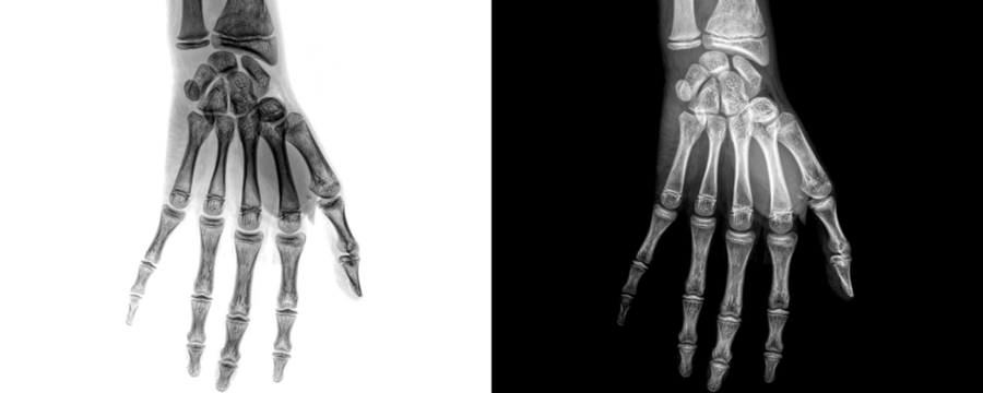 Wrist Joint Anterior View X-Ray Radiograph Showing Bone Alignment and Soft Tissue Structures for Diagnosis of Fractures, Arthritis, Isolated on Transparent Background