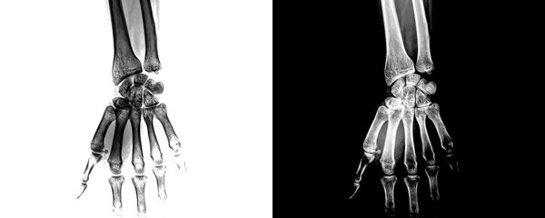 Wrist Anterior View X-Ray Radiograph Showing Clear Visualization of Joint Spaces, Bone Structure, Accurate Diagnosis of Fractures and Arthritis Isolated on Transparent