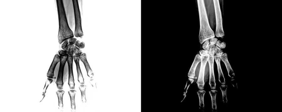 Wrist Anterior View X-Ray Radiograph Showing Clear Visualization of Joint Spaces, Bone Structure, Accurate Diagnosis of Fractures and Arthritis Isolated on Transparent