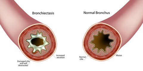 Bronchiectasis and Normal Bronchus Cross Section Medical Illustration. Airway Damage Comparison in Bronchiectasis Anatomy Diagram