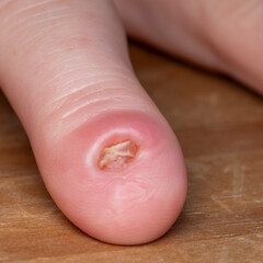 Fototapeta premium Partial amputated finger with red swelling and infected finger nail growth. Finger shown has one year of healing since dog bite.