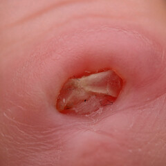 Fototapeta premium Partial amputated finger with red swelling and infected finger nail growth. Finger shown has one year of healing since dog bite.