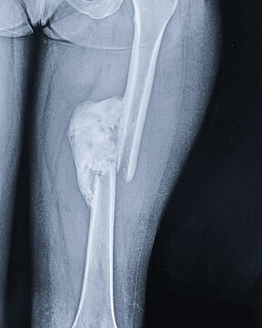Chronic Femur Fracture with Extensive Callus and Calcified Soft Tissue on X-ray