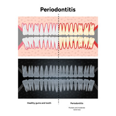 Hand-drawn dental illustration featuring expanded upper and lower rows of teeth with periodontal problems, healthy teeth. Computer tomography (CT) scans that highlight bone loss, gum recession 