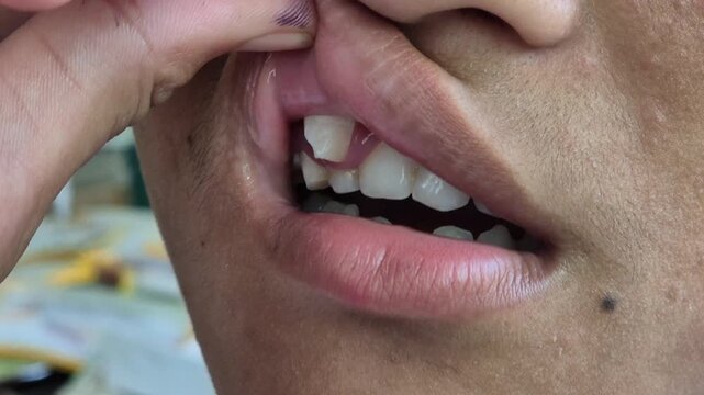 Asian boy teeth grow out of place in the upper gums.