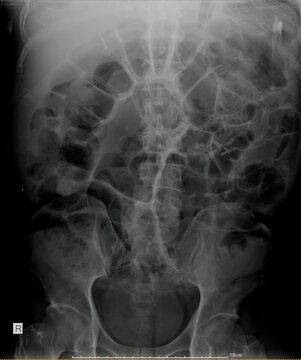 Abdominal X-ray in left lateral decubitus shows dilated bowel loops with multiple air&ndash;fluid levels and free intraperitoneal air, suggesting ileus with possible gastrointestinal perforation.