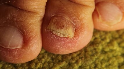 Close-up toenail with severe fungal infection, showing yellow thickened nail damage. Ideal for medical education, dermatology studies, pharmaceutical ads, foot-care marketing, health awareness content