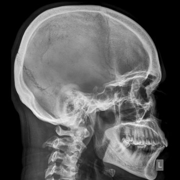 x ray of human skull lateral view ,
Lateral Skull Radiograph,Cranial Bones,