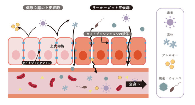 リーキーガット症候群をわかりやすく表した小腸上皮細胞の断面図