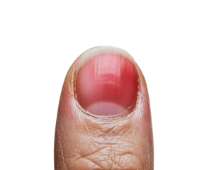 Close up of finger nail with subungual hematoma isolated on transparent background