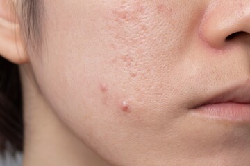 Close-up of facial skin with acne, enlarged pores and texture imperfections