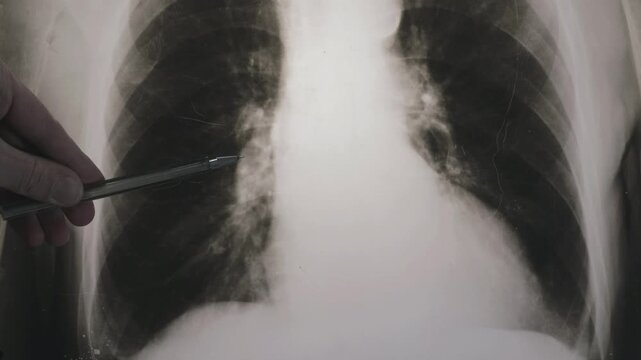Doctor learn X-ray picture with pneumonia, fluorography. Diagnostics of human lung and respiratory tract diseases. 4k footage.
