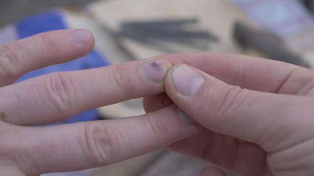 Hand with nail hematoma caused by impact during physical labor. Dark bruising highlights injury risks in manual work. Background shows blurred hammer and nails, pointing to construction work