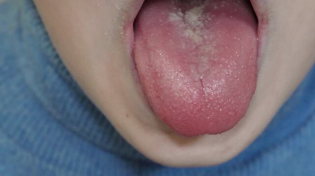 child shows tongues of scarlet fever disease, child opened his mouth and shows his tongue, scarlet fever