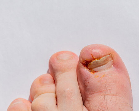Close-up of an injured human toe with an infected or ingrown nail on a white background.