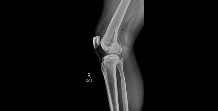 
Knee x-ray lateral standing view showing femur, tibia, fibula and patella. Weight-bearing radiograph for diagnostic examination of knee joint alignment and arthritis