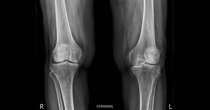 Both knees x-ray AP standing view showing bilateral knee joints, femurs, tibias and fibulas. Weight-bearing radiograph for examination of knee alignment and arthritis