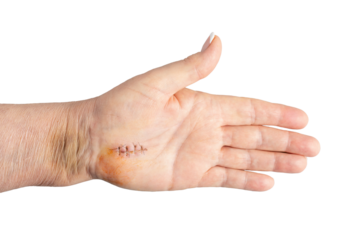 Fresh healing scar one week after surgery on tendons and nerve, Carpal tunnel syndrome treatment. Female hand isolated on white background