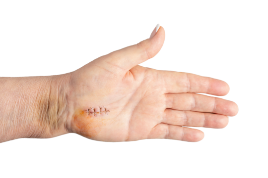Fresh healing scar one week after surgery on tendons and nerve, Carpal tunnel syndrome treatment. Female hand isolated on white background