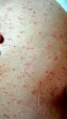 Fototapeta premium Human skin experiencing a widespread red rash with small bumps, indicating various dermatological conditions like allergic reactions, shingles, or other skin infections