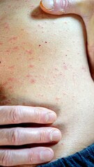 Adult experiencing a widespread skin rash, possibly shingles or another allergic reaction, causing discomfort and redness across the back, suggesting a dermatological condition or illness