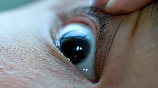 Close-Up Eye Drop Application for Irritation Relief