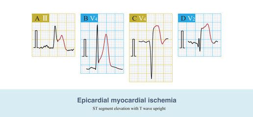 When epicardial coronary artery thrombosis occurs, the lumen is completely  or subtotal occluded, ischemia affects epicardial myocardium, and ST segment elevation with T wave upright of the ECG.
