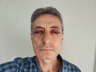 Obraz premium Close-up of a male patient's face with closed eyes showing visible sutures after upper eyelid blepharoplasty and Muller muscle resection surgery during the early post-operative recovery phase.