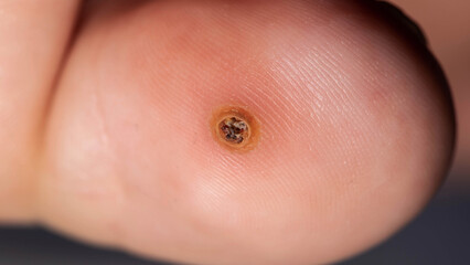 Macro View Of Plantar Wart On Toe. A Close-Up Shot Shows A Verruca Caused By Human Papillomavirus.