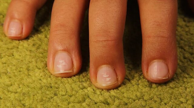 Child ’s fingernail displaying leukonychia white spots specifically diagnosed as resulting from calcium and zinc deficiency, ideal for medical education, pediatric nutrition awareness and healthcare.