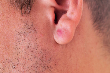 Skin condition on the ear of a young man showing irritation and raised bump near facial hair, red pimple