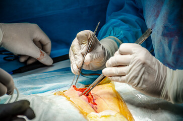 Surgical tweezers in the hands of a surgeon wearing white sterile gloves during an operation. The surgeon operates on a patient with surgical instruments.