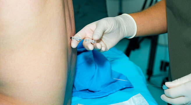 An anesthesiologist administers spinal anesthesia to a patient using a special needle. A close-up of the anesthesiologist's hands, wearing sterile gloves, holding an epidural anesthesia needle.