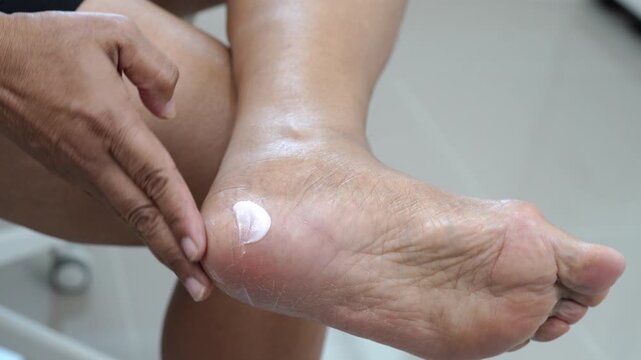 Asian woman check feet with crack and dry heel skin, Diabetic Foot.