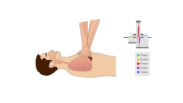 2D medical animation showing correct CPR chest compression technique on an unconscious person for resuscitation training