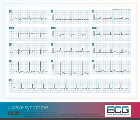J wave syndrome is a malignant arrhythmia syndrome, with obvious J-waves on the electrocardiogram, clinical malignant ventricular arrhythmias, and even sudden death.

