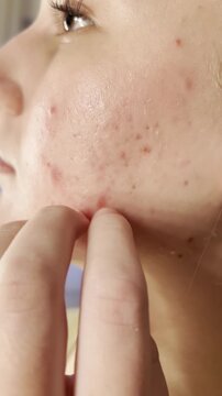 Girl touching irritated, blemish-prone skin on her cheek. Close-up of acne discomfort and real skin texture in a skincare-related video.
