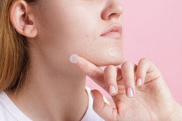 Side view teen girl with hydrocolloid acne patches on chin for spot treatment