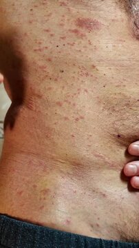 Middle-aged man showing a severe case of shingles on his torso, a painful skin condition caused by the varicella-zoster virus, highlighting the red spots and blisters on his abdomen