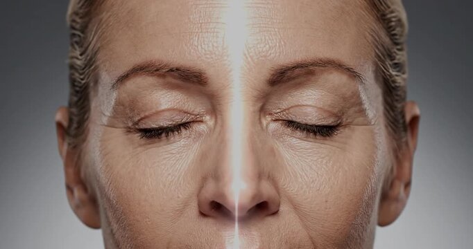 Split face comparison of woman before and after eyelid surgery.