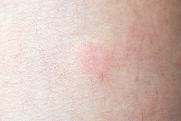 Skin allergy rash dermatitis texture close up background