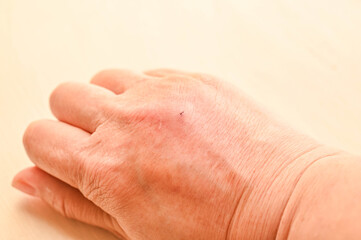 ペットのネコに噛まれて腫れた拳