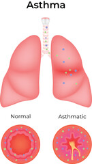 Asthma Normal vs Asthmatic Lungs and Bronchioles Comparison Vector Illustration